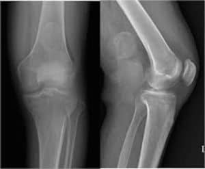 Synovial Sarcoma 1